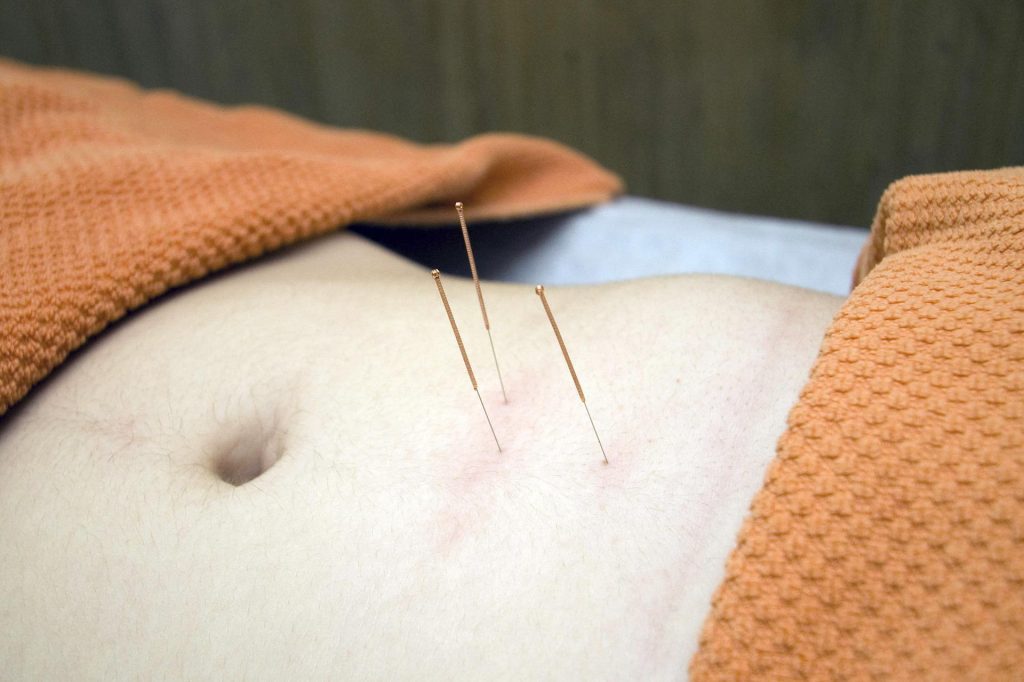 Acupuncture needles