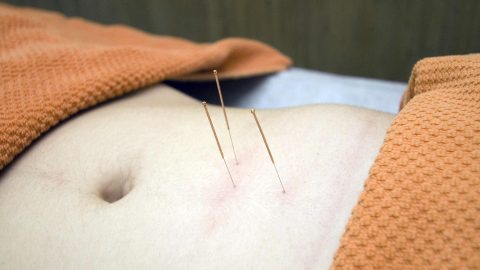 Acupuncture needles