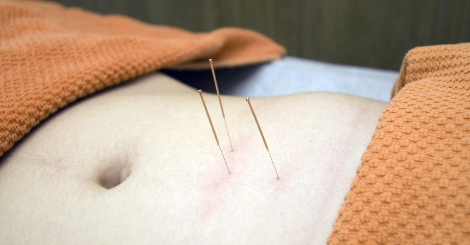 Acupuncture needles