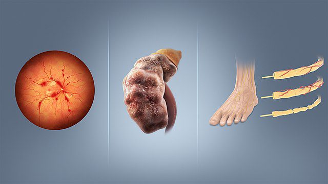 Retinopathy, nephropathy, and neuropathy