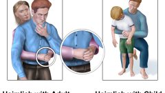 National Heimlich Maneuver Day