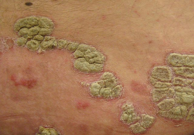 psoriasis