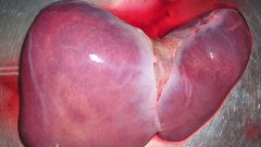 liver transplant