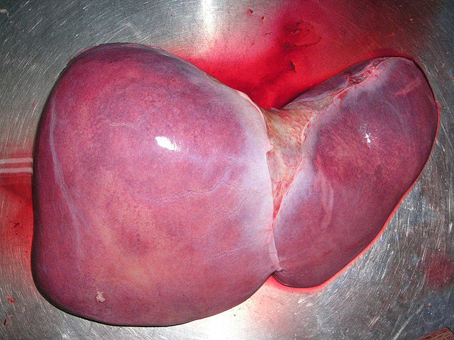 liver transplant