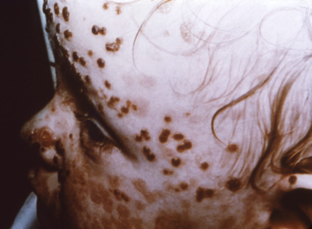 smallpox