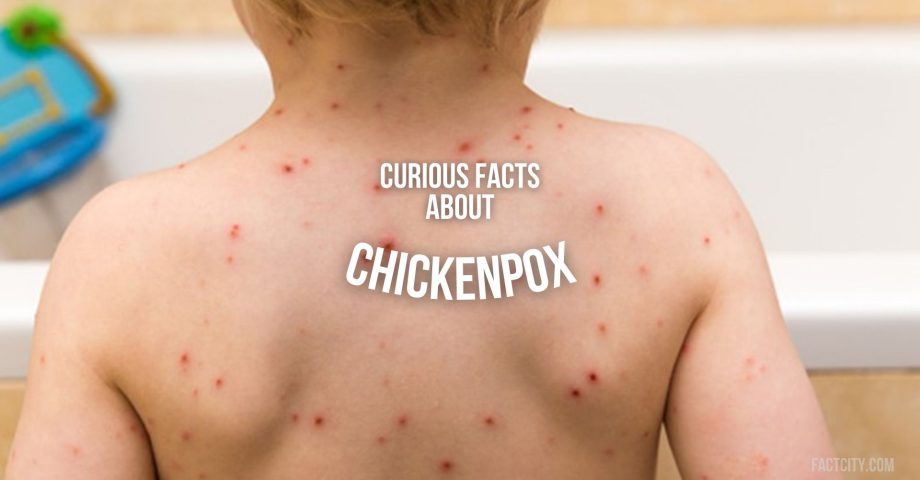 chickenpox